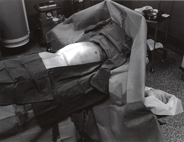 The body after the transplantation.