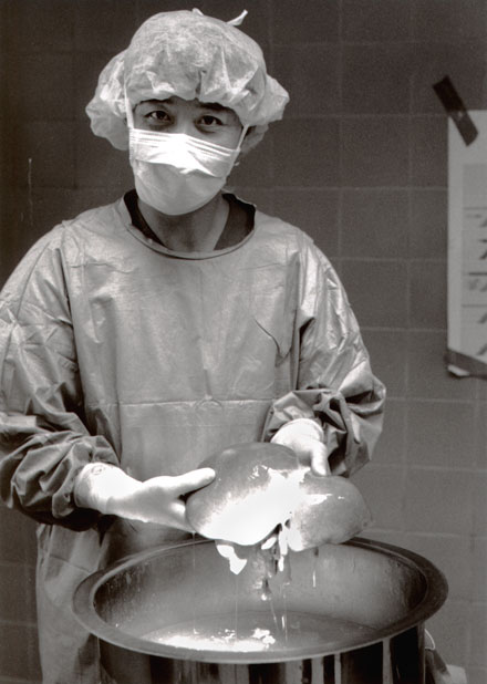 Surgeon with liver.