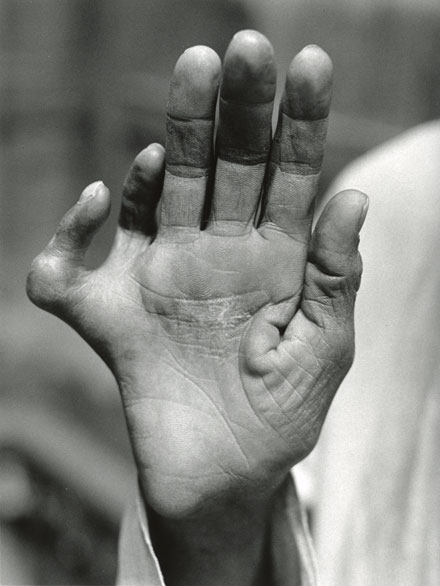 Sadhu with six fingers and six toes palm