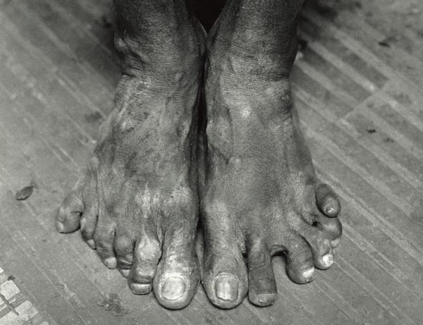 Sadhu with six fingers and six toes toes